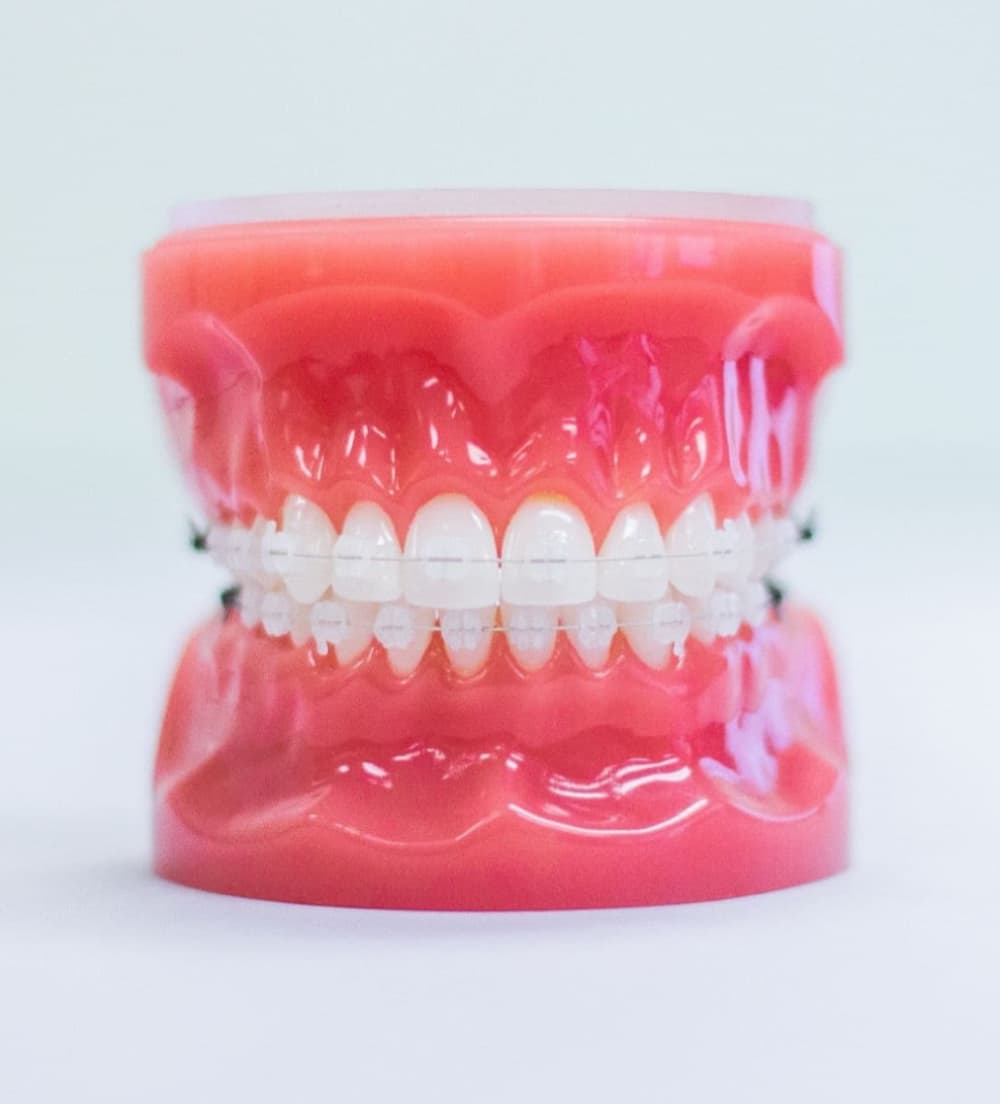 clear braces on plastic model